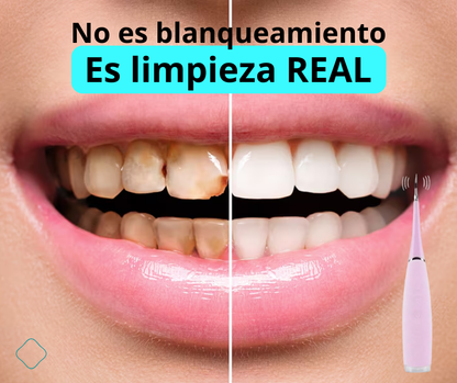 SonicWhite™ - Limpiador Dental por Ultrasonido Pro