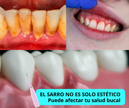 SonicWhite™ - Limpiador Dental por Ultrasonido Pro